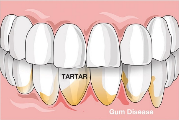 علاج امراض اللثة